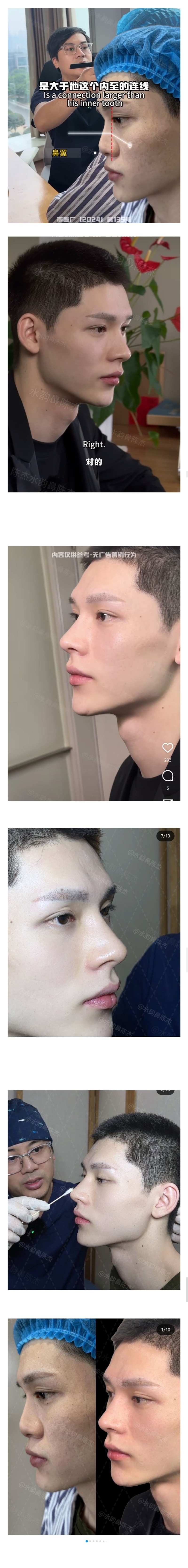 남자 코 성형 레전드 