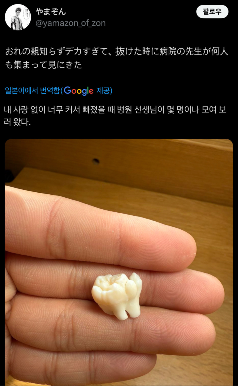 사랑니가 너무 커서 의사들이 구경왔다는 일본인 